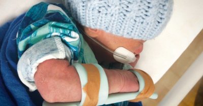 Kiwi invention to prevent NICU babies' skin injuries a success.jpg Kiwi invention to prevent NICU babies' skin injuries a success.jpg